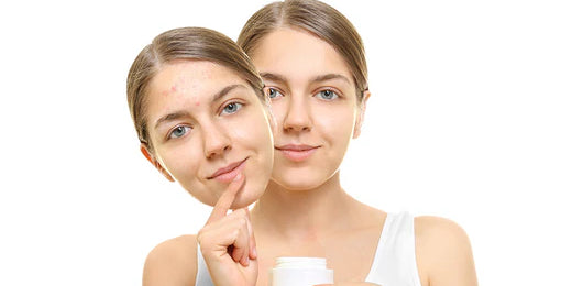 3 Top Tips on How to Get Rid of Acne