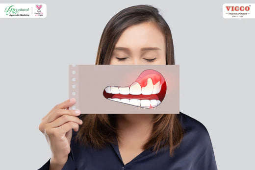 What is Gingivitis : Types, Symptoms and Treatment