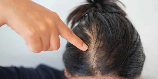 Causes of Thinning Hair in Women